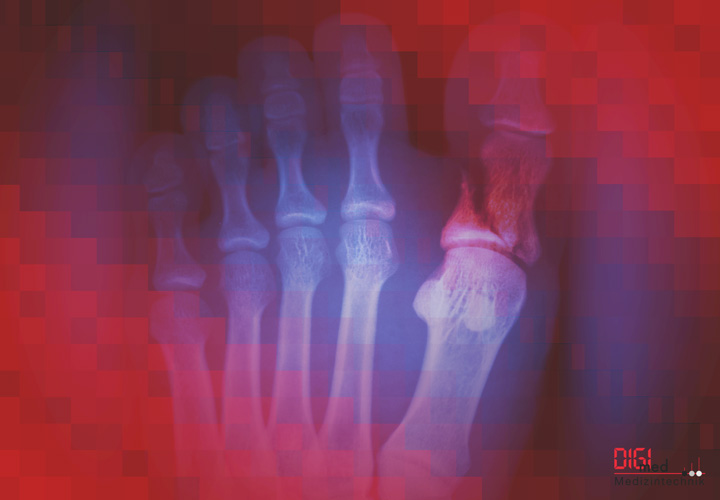 Fussfraktur Fussfraktur