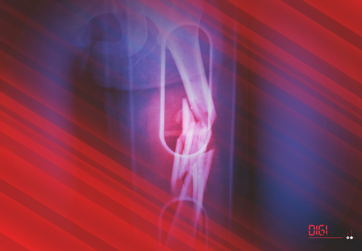 Gelenkbruch Gelenkbruch